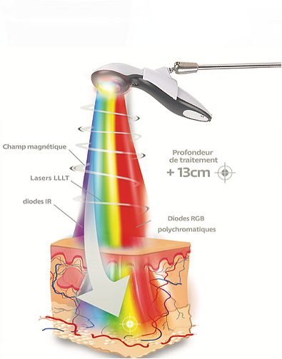 La photobiomodulation agit en profondeur pour le traitement des blessures